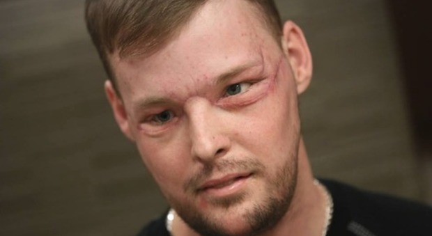 Usa, tentò il suicidio sparandosi in faccia: dopo 10 anni ha un volto nuovo