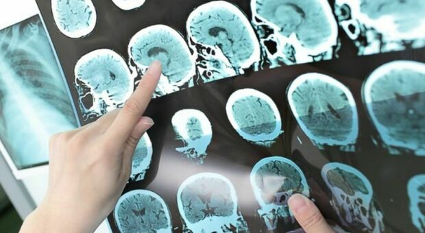 Alzheimer, un farmaco rallenta il declino cognitivo. «Svolta epocale, malattia potrebbe essere curabile»