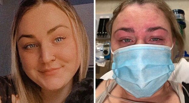 «Sono allergica al Covid»: ragazza mostra il volto gonfio e con eruzioni cutanee. Ma i medici: «Non è pericoloso»