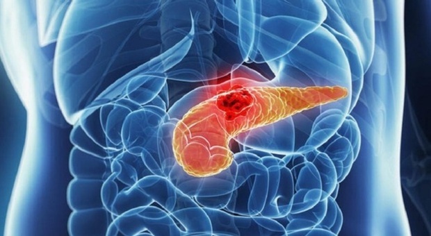 Tumore al pancreas, diagnosi possibile fino a tre anni prima: la scoperta dei ricercatori dell'Università di Oxford